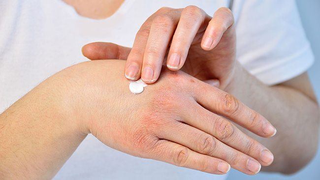 アトピー性皮膚炎の患者さんの約8割が「疾病負荷」を抱えることが明らかに。最も支障があるのは「睡眠」